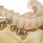 льготное протезирование зубов
